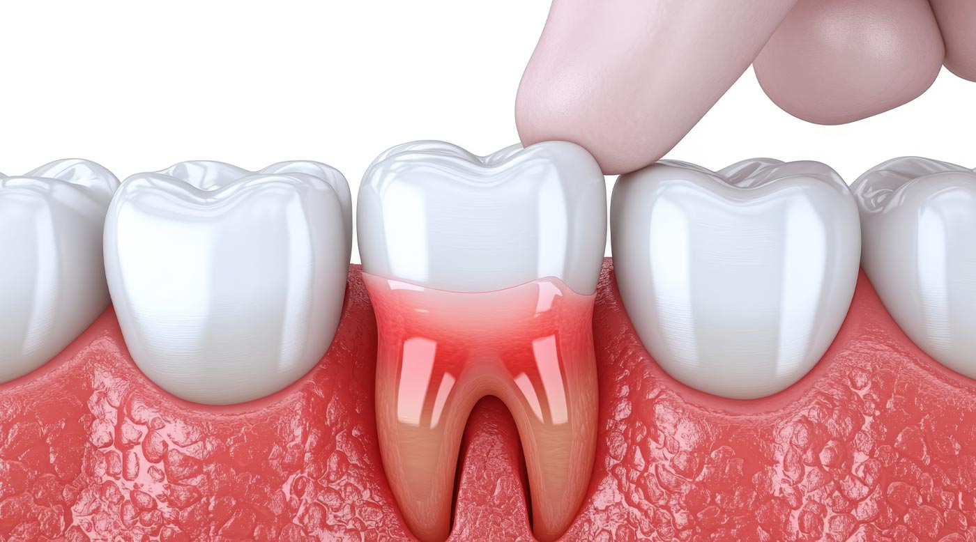 Grafik zeigt entzündete Zahnwurzel und gesunde Zähne
